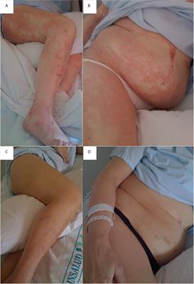 Case Report: Extensive Dermatitis Secondary to Severe Malnutrition, Zinc and Vitamin Deficiencies After Malabsorptive Bariatric Surgery